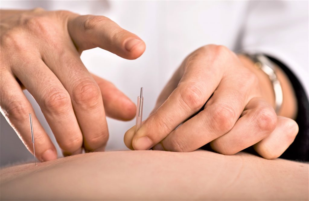 Acupuncture by Tzu Chi Clinic
